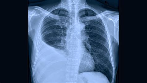 Derrame Pleural O Que é Causas Sintomas E Tratamento