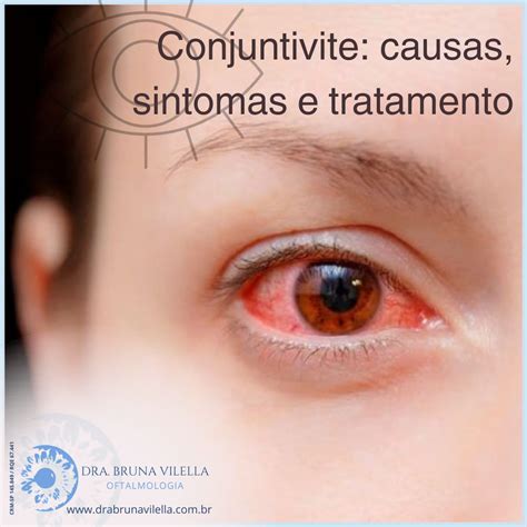 Conjuntivite Causas Sintomas E Tratamento