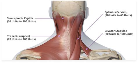 Cervical Dystonia Dosing And Administration Botox One® Botox® Onabotulinumtoxina