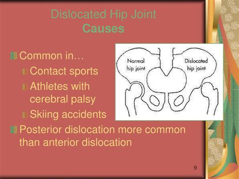 Ppt Injuries Of The Hip And Groin Powerpoint Presentation Free