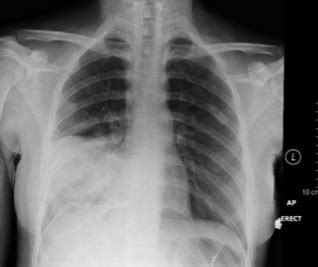 Pneumonia Bronchiectasis Lung Abscess And Pleural Effusion Flashcards