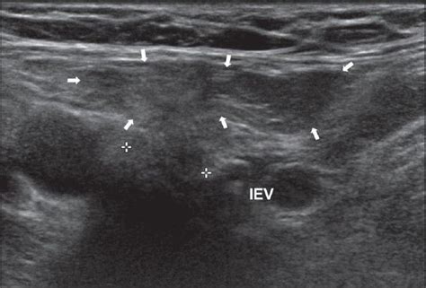 7: Long axis USG image through the right inguinal canal. The indirect ...