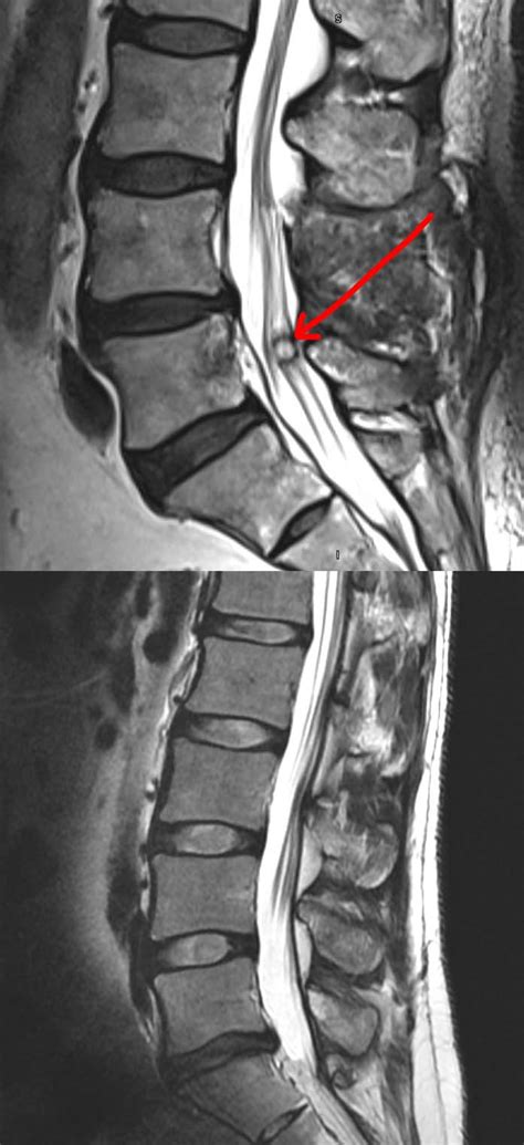 Synovial Cyst Lumbar MRI