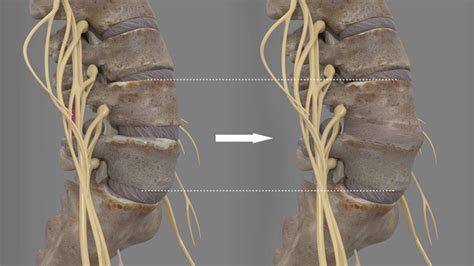 Posterior Lumbar Fusion Shimspine