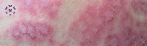 Cutaneous Lupus Kaleidoscope Fighting Lupus