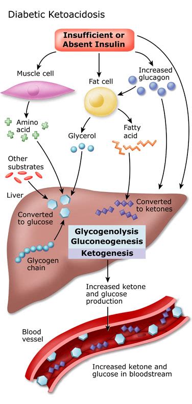 Diabetic Ketoacidosis DKA Stepwards