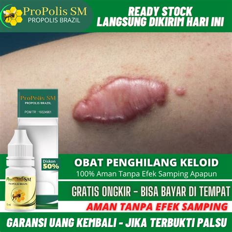 Jual Obat Penghilang Keloid Obat Keloid Menonjol Tahunan Obat Keloid