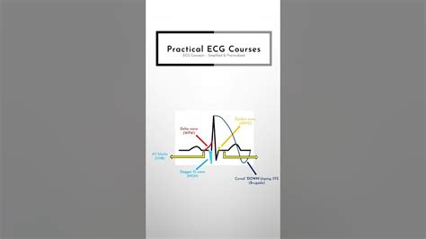 Visual Mnemonic For Causes Of Syncope What To Look For On An Ecg