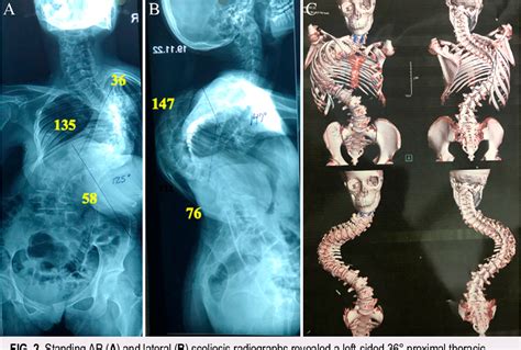 PDF Three Stage Correction Of Severe Idiopathic Scoliosis With