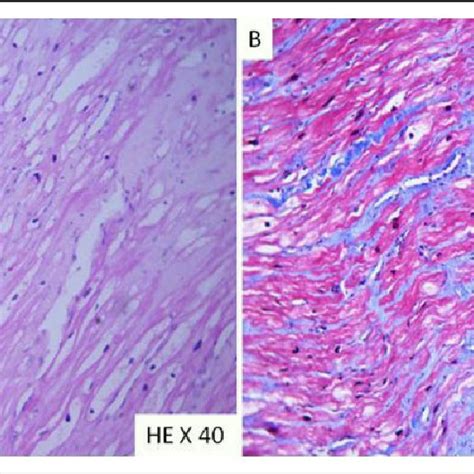 Myocardial Biopsy A Myocyte Hypertrophy With Nucleomegaly And