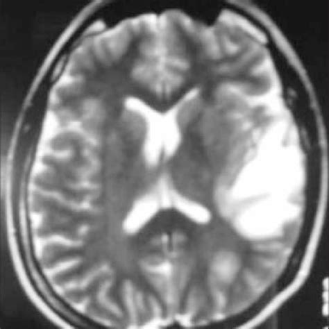 Brain Mri Axial T2 Weighted Fse Image Showing A Left Temporo Insular