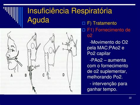 Ppt Insufici Ncia Respirat Ria Aguda Powerpoint Presentation Free