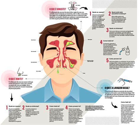 Qual A Diferen A Entre Rinite E Sinusite Jk Off