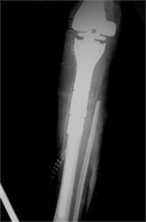 Osteosarcoma Conventional Bone Tumor Cancer