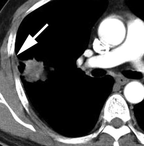 Eosinophilic Lung Diseases A Clinical Radiologic And Pathologic