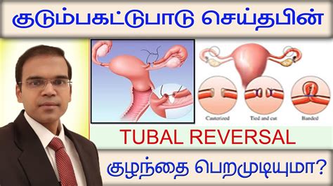 Tubal Reversal Benefits Of Tubal Reversal Surgery Laparoscopic Tubal