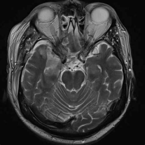 Brain MRI showing abnormal enhancement around the right optic nerve and ...