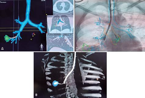 New Endobronchial Ultrasound Ebus Techniques Einstein S O Paulo