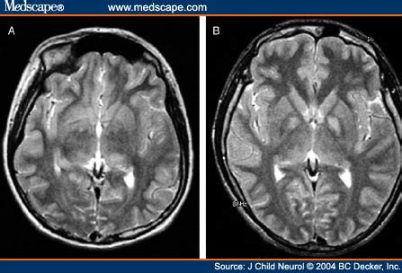 T2-Weighted Hyperintensities (Unidentified Bright Objects) in