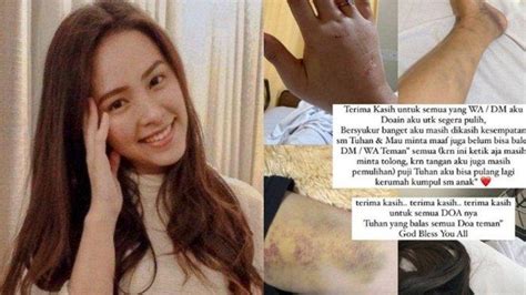 Masih Pakai Kursi Roda Lady Nayoan Ungkap Kondisi Minggu Usai