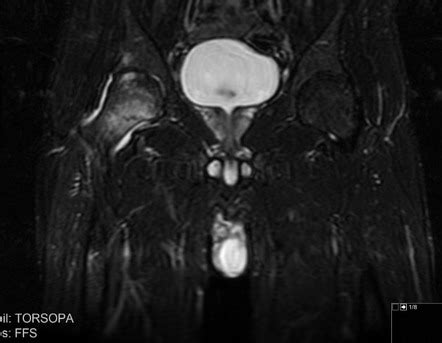 Femoral neck stress fracture | Radiology Case | Radiopaedia.org