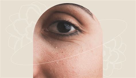 Что такое милиумы и как избавиться от белых угрей на лице – HEROINE