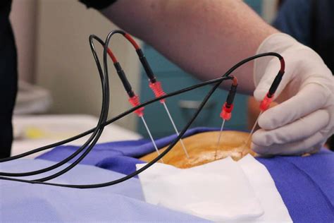 What Is Radiofrequency Ablation RFA A Guide To Pain Relief