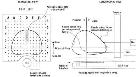 Illustration Of How Transperineal Template Prostate Mapping Biopsies Download Scientific