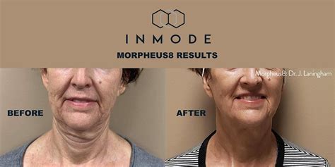 What Is Morpheus Treatment Wave Plastic Surgery