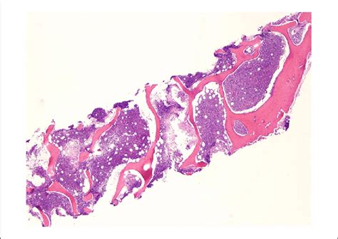 A Micrograph 20 X Of Bone Marrow Core Biopsy Obtained From The