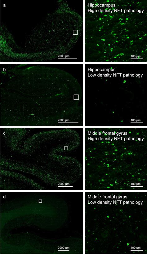 Density Of Neurofibrillary Tangle Nft Pathology Varied Considerably