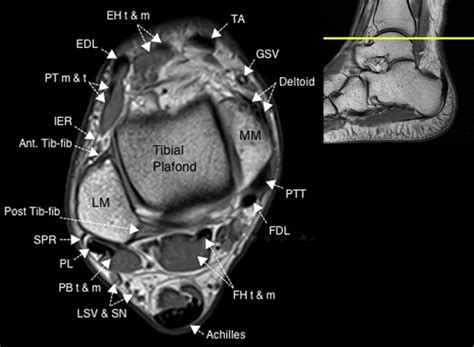 Normal Magnetic Resonance Imaging Anatomy Of The Ankle And Foot