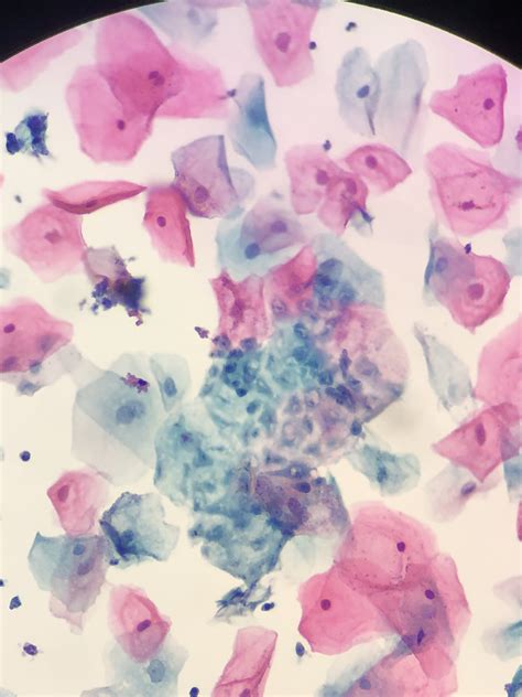 Pathology Outlines Trichomonas Vaginalis