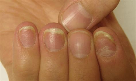Psoriasis And Nail Pitting Uncovering The Hidden Connection