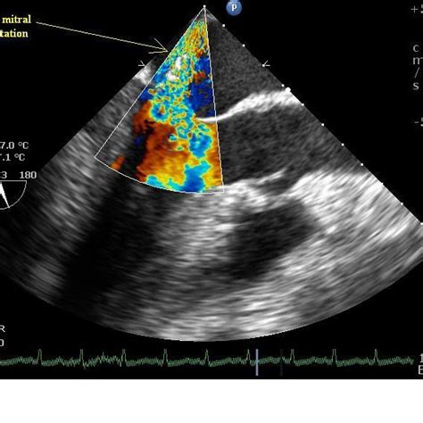 Midesophageal Long Axis Transesophageal Echocardiographic View Showing Download Scientific