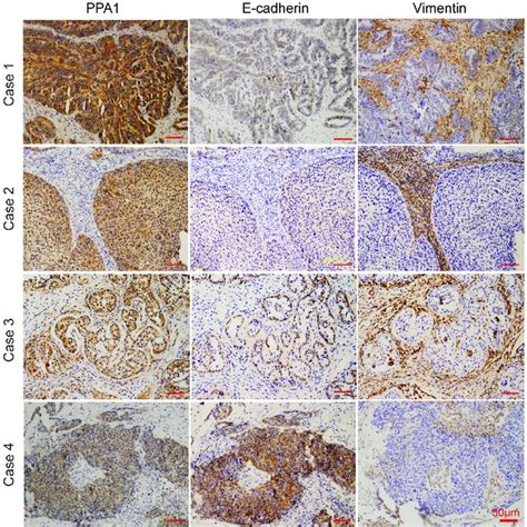 IHC Staining Revealed Correlations Between PPA1 And E Cadherin Or