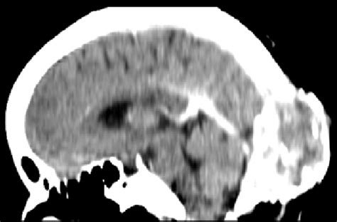 Contrast Enhanced Sagittal Reconstruction Ct Scan Images Showing The Download Scientific