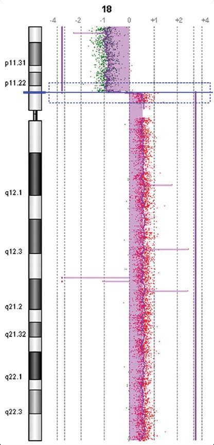 Prenatal Diagnosis And Molecular Cytogenetic Analysis Of A De Novo Isodicentric Chromosome 18