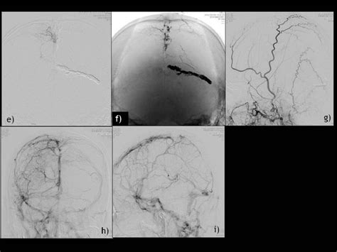 Figure 4 from Borden type3 superior sagittal sinus dural arteriovenous ...