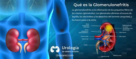 ¿Qué es la glomerulonefritis? | PPT
