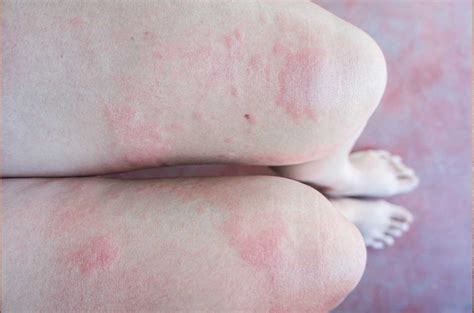 Heat Urticaria Chronic Urticaria Urticaria Alergica Urticaria Causes