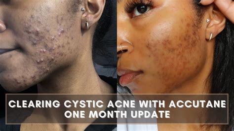 CLEARING CYSTIC ACNE WITH ACCUTANE One Month Update Side Effects Of