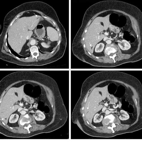 Abdominal Contrast Enhanced Computed Tomographic Images Of A