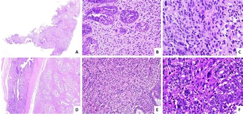 Morphological Features Of A Malignant Phyllodes Tumor On Vabb And