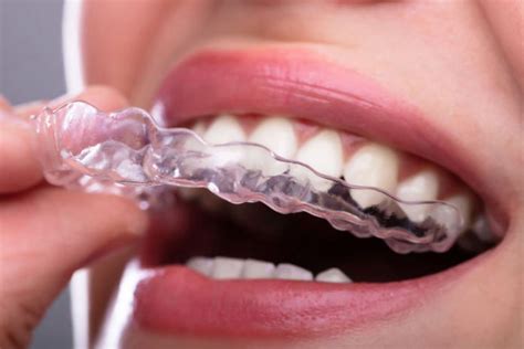 Invisible Braces In Albuquerque Nm Orthodontic Services Success