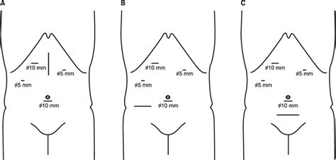 The Incisions To Retrieve The Specimen A An Upper Midline Incision