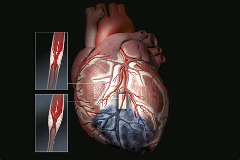 Supervised Ai Enabled Vectorcardiography Superior To Conventional