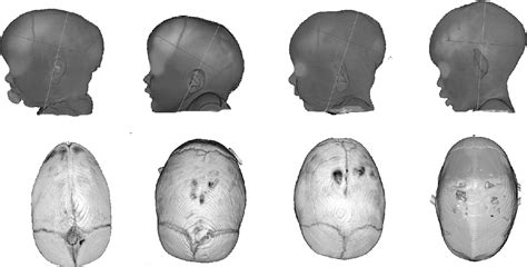 Figure 4 from New Scaphocephaly Severity Indices of Sagittal Craniosynostosis: A Comparative ...