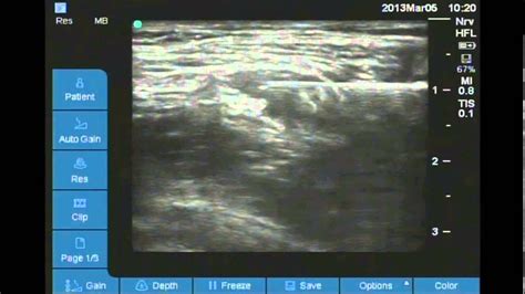 Ultrasound Guided Femoral Nerve Block Youtube