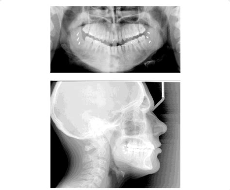 Post Surgical Panoramic And Cephalometric Radiographs Download